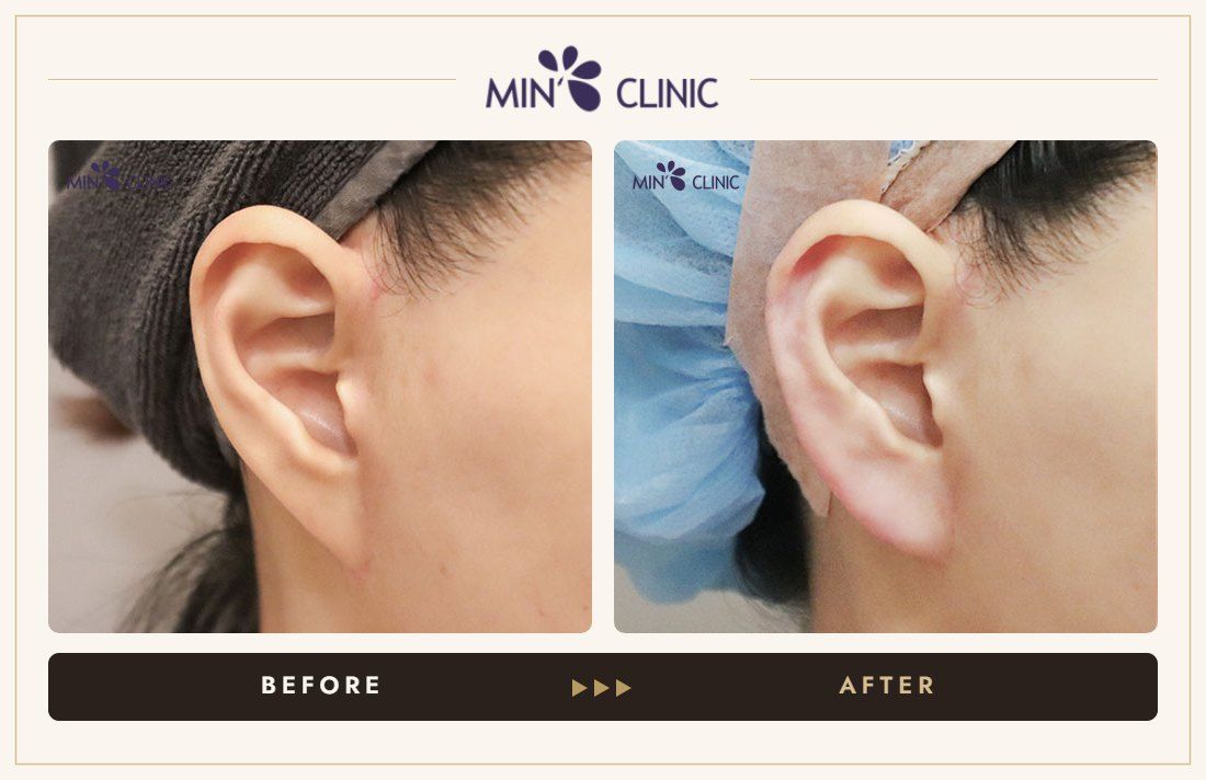 Earlobe filler before and after, case 1 – MIN Clinic Seoul