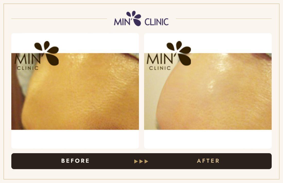 Forehead filler before and after, case 1 – MIN Clinic Seoul