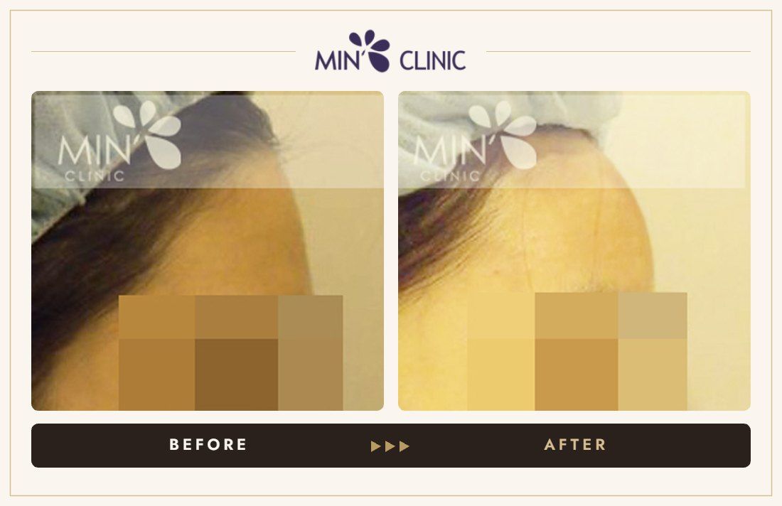 Forehead filler before and after, case 2 – MIN Clinic Seoul