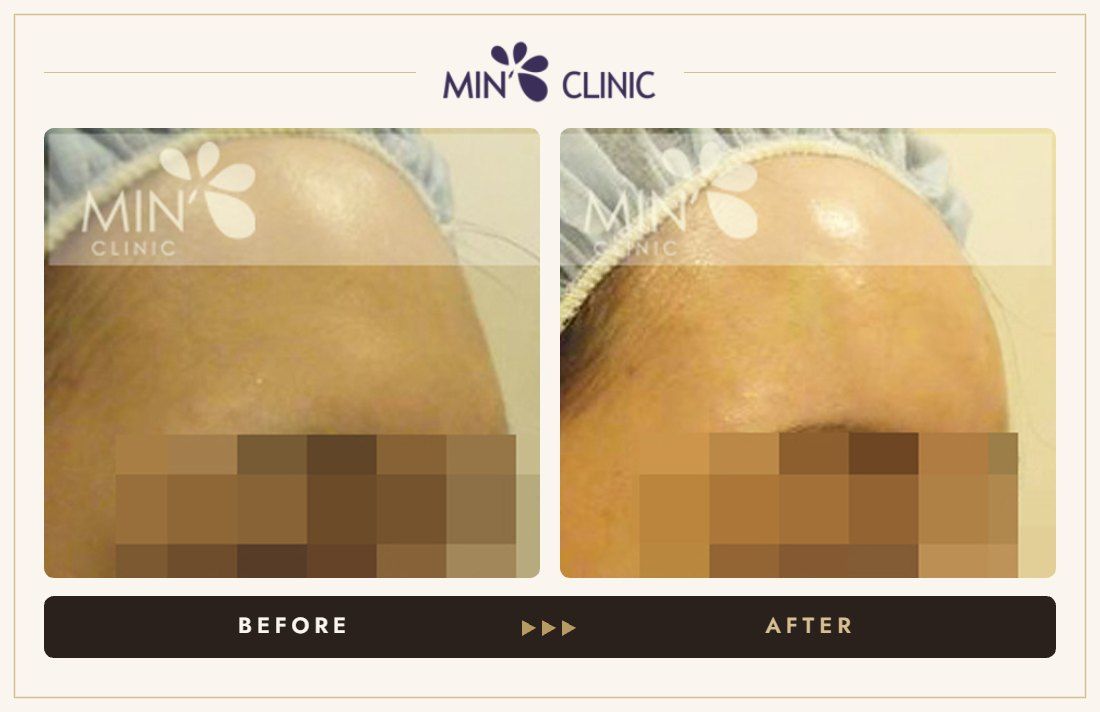 Forehead filler before and after, case 3 – MIN Clinic Seoul