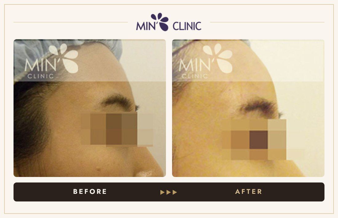 Forehead filler before and after, case 4 – MIN Clinic Seoul