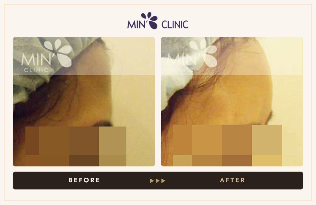 Forehead filler before and after, case 5 – MIN Clinic Seoul