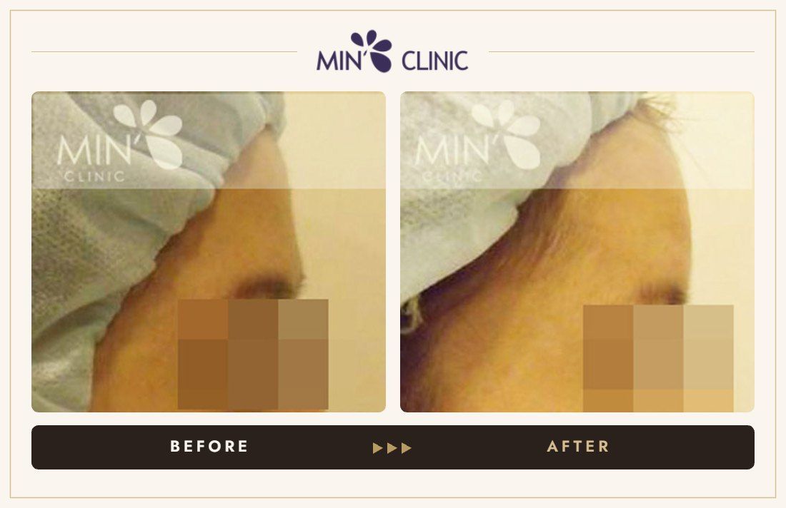 Forehead filler before and after, case 6 – MIN Clinic Seoul