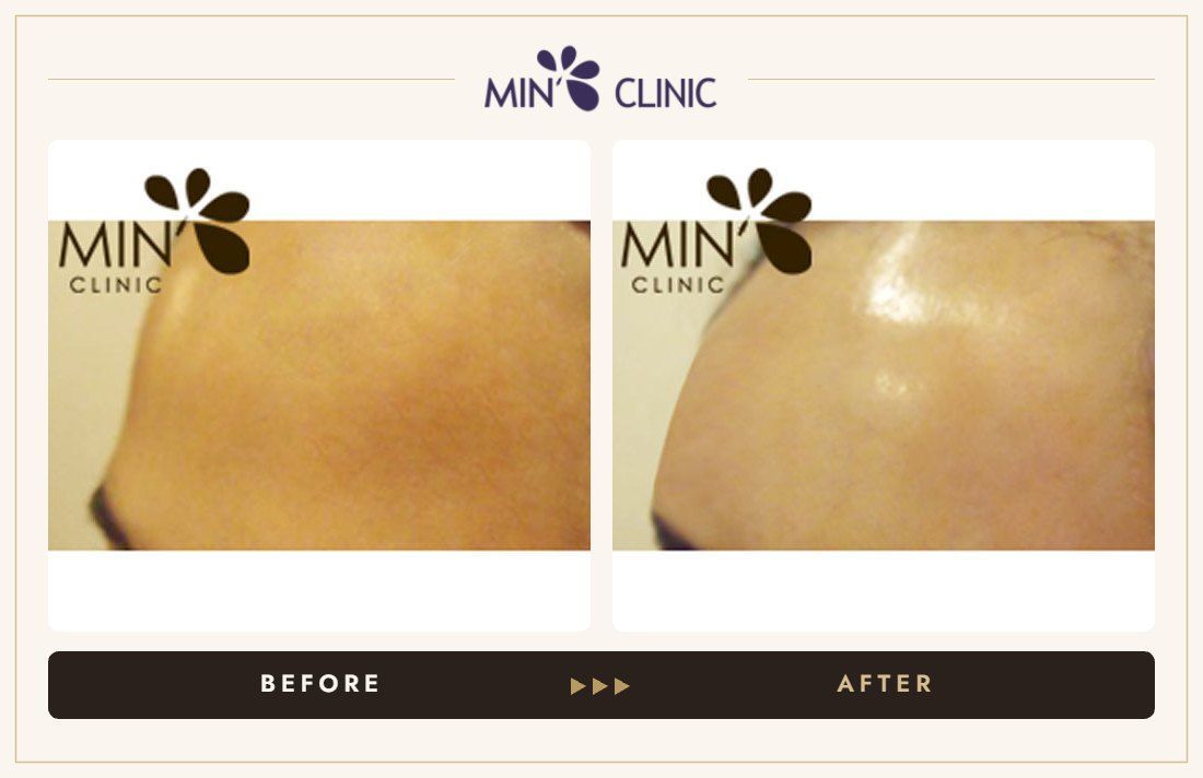 Forehead filler before and after, case 7 – MIN Clinic Seoul