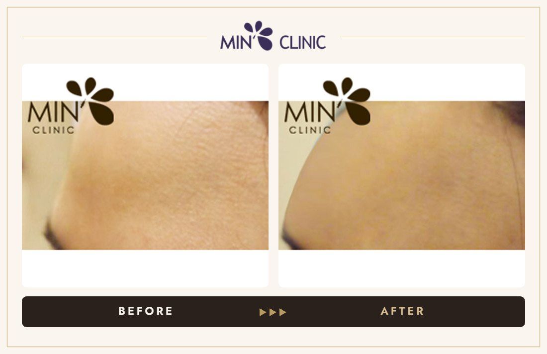 Forehead filler before and after, case 8 – MIN Clinic Seoul