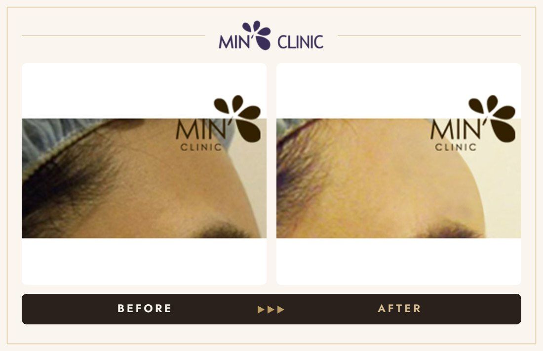 Forehead filler before and after, case 9 – MIN Clinic Seoul