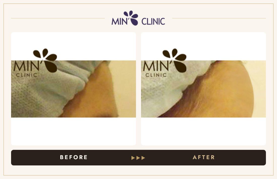 Forehead filler before and after, case 10 – MIN Clinic Seoul