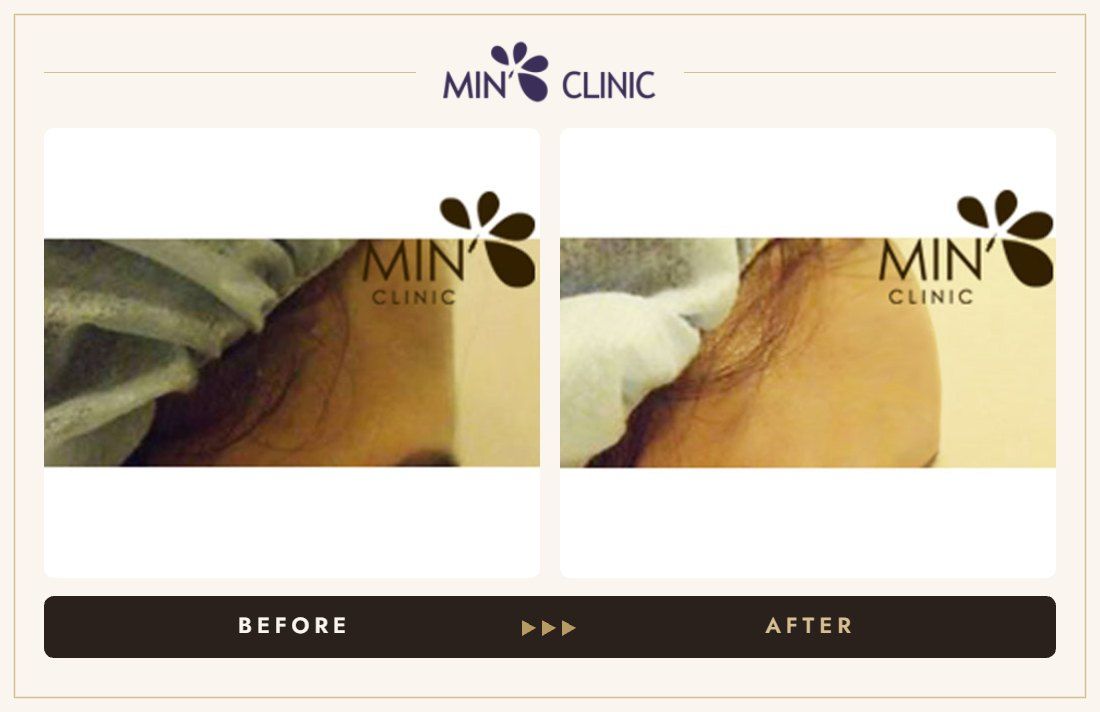 Forehead filler before and after, case 11 – MIN Clinic Seoul