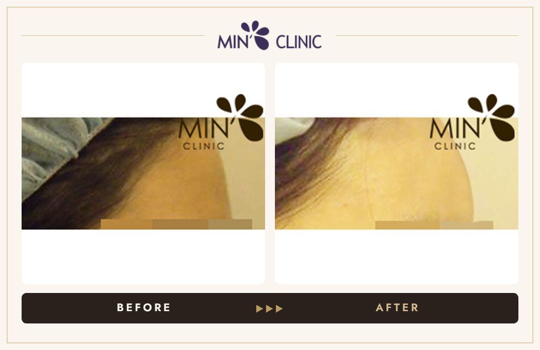 Forehead filler before and after, case 12 – MIN Clinic Seoul