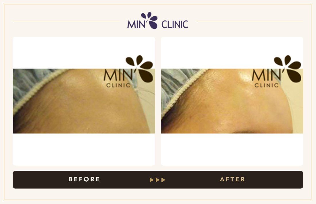 Forehead filler before and after, case 13 – MIN Clinic Seoul