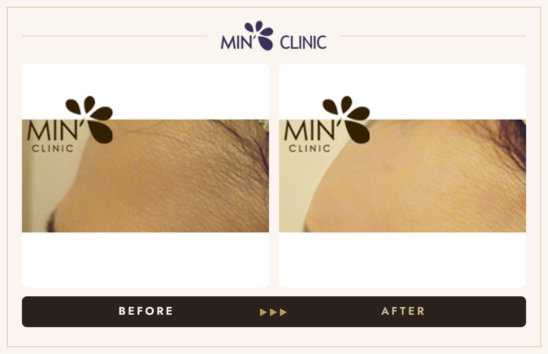Forehead filler before and after, case 14 – MIN Clinic Seoul