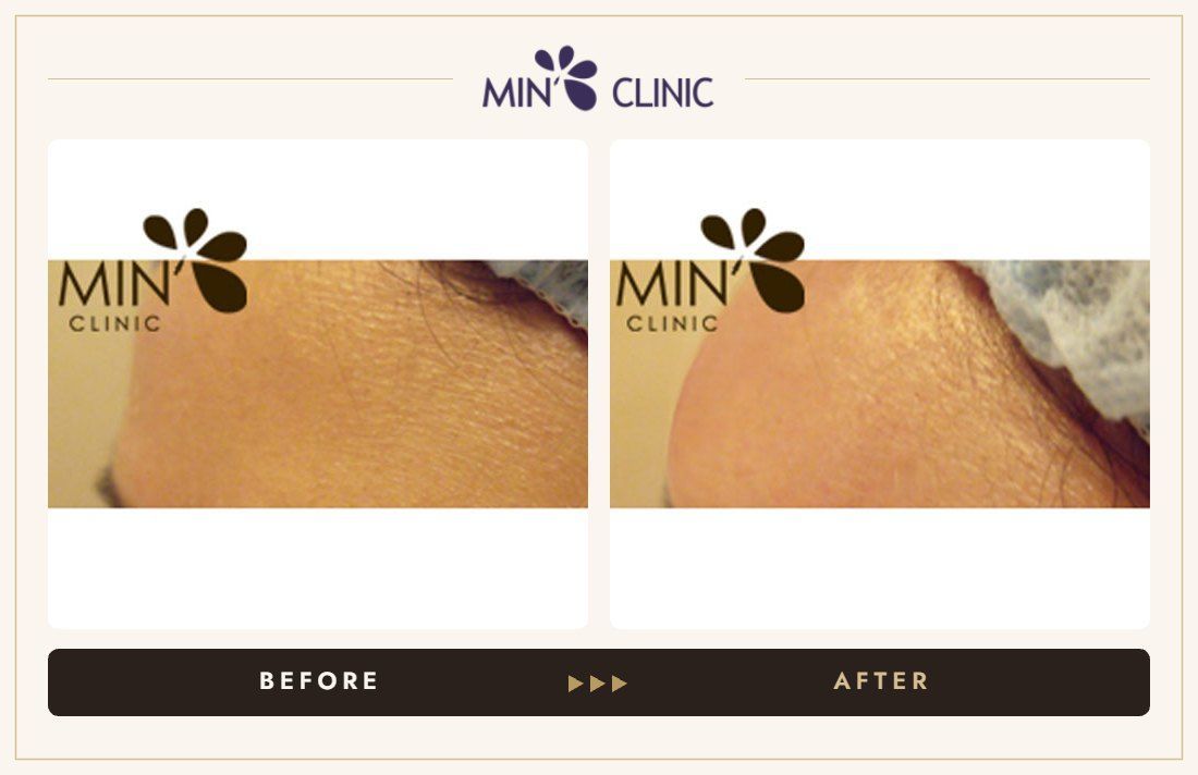 Forehead filler before and after, case 15 – MIN Clinic Seoul