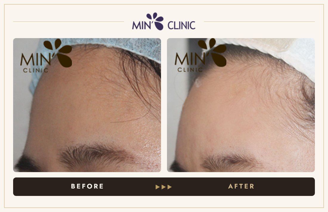 Forehead filler before and after, case 16 – MIN Clinic Seoul