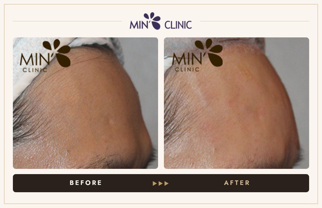 Forehead filler before and after, case 17 – MIN Clinic Seoul