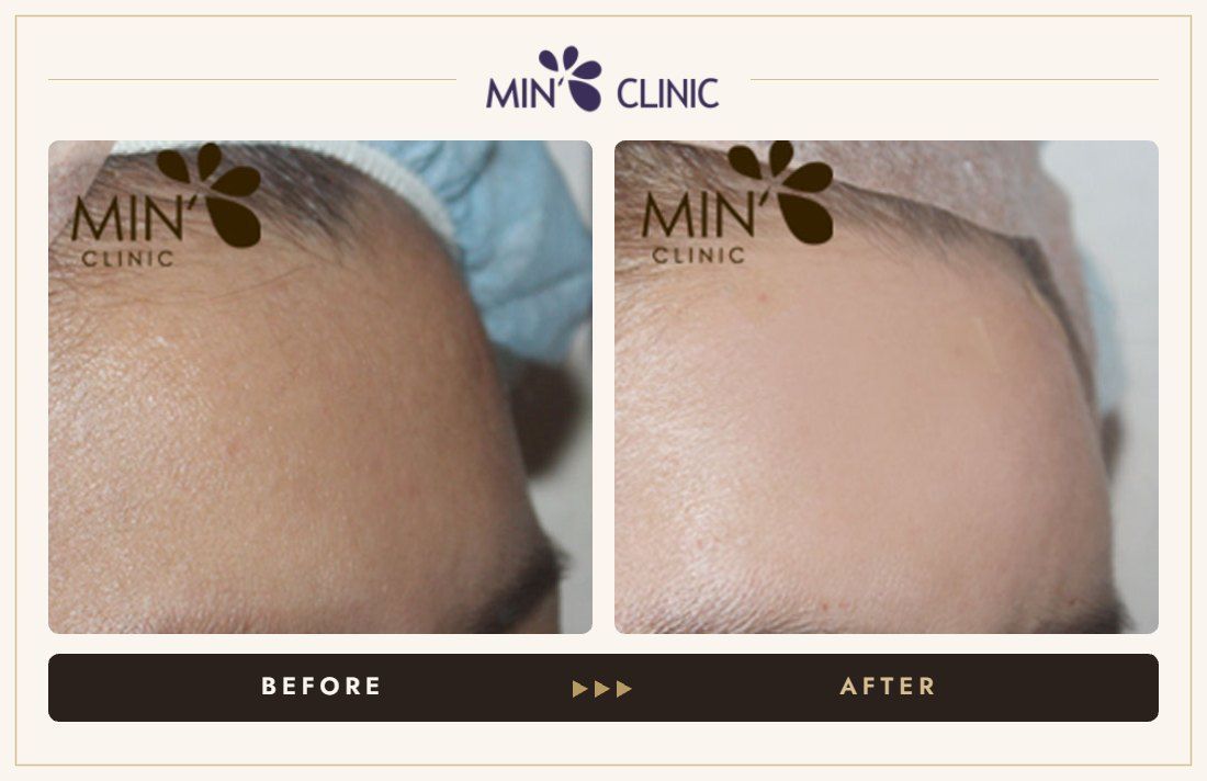 Forehead filler before and after, case 18 – MIN Clinic Seoul