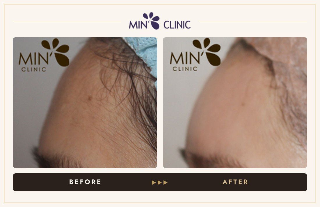 Forehead filler before and after, case 19 – MIN Clinic Seoul