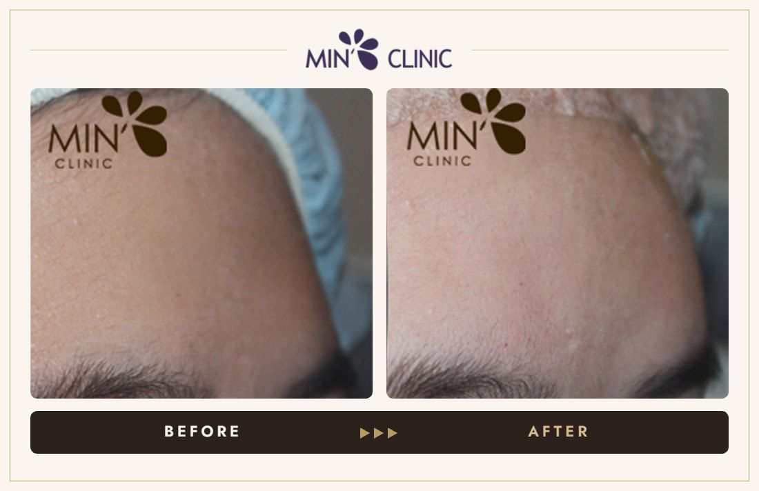 Forehead filler before and after, case 20 – MIN Clinic Seoul