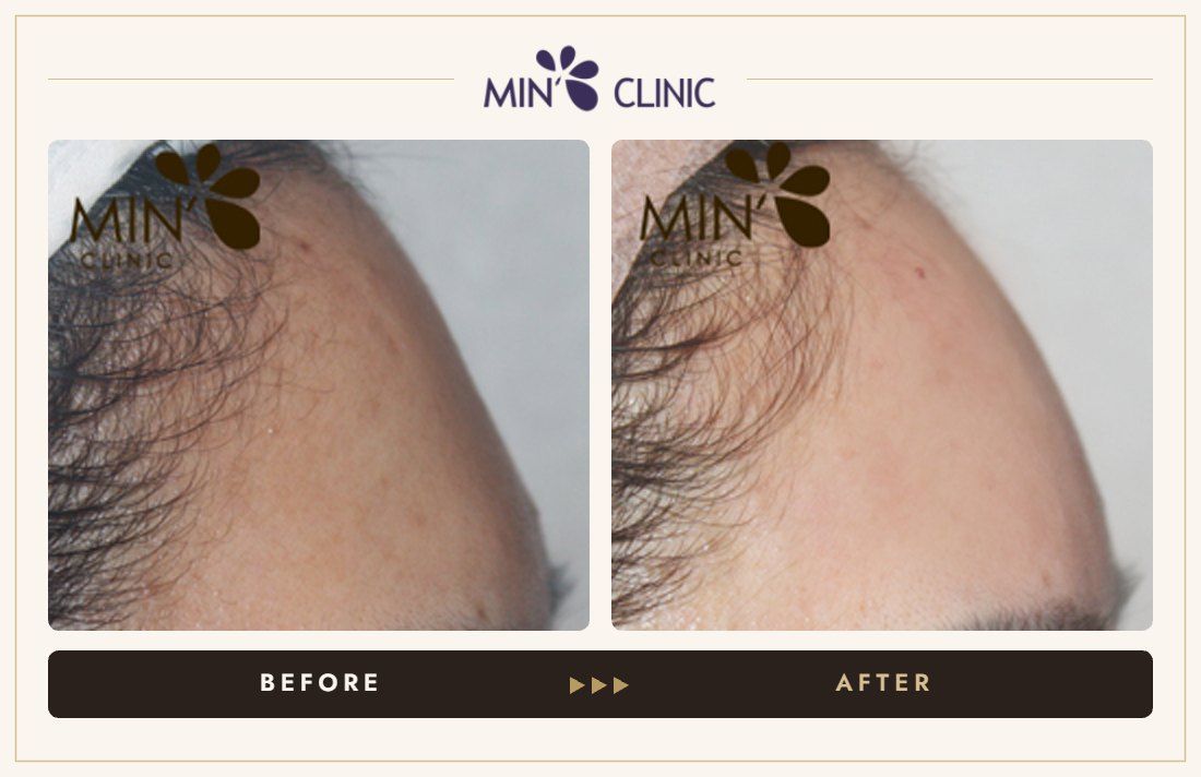 Forehead filler before and after, case 21 – MIN Clinic Seoul