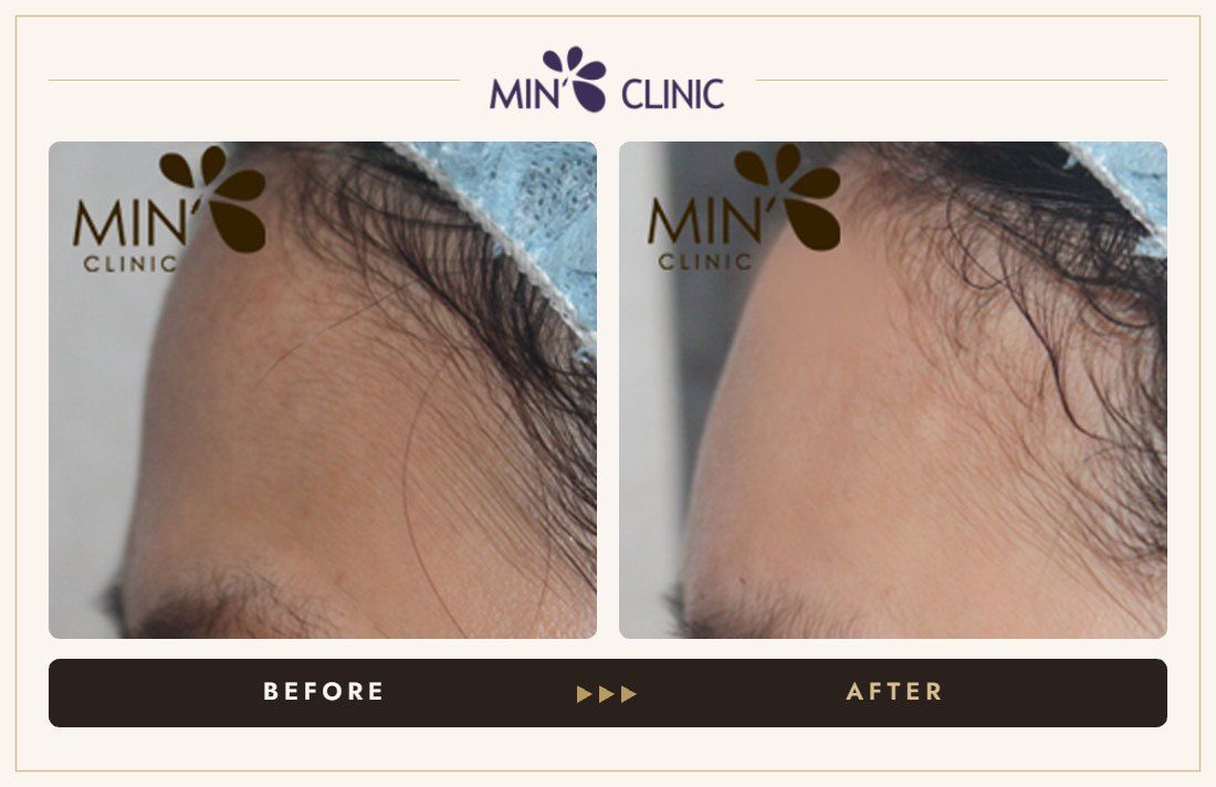 Forehead filler before and after, case 22 – MIN Clinic Seoul
