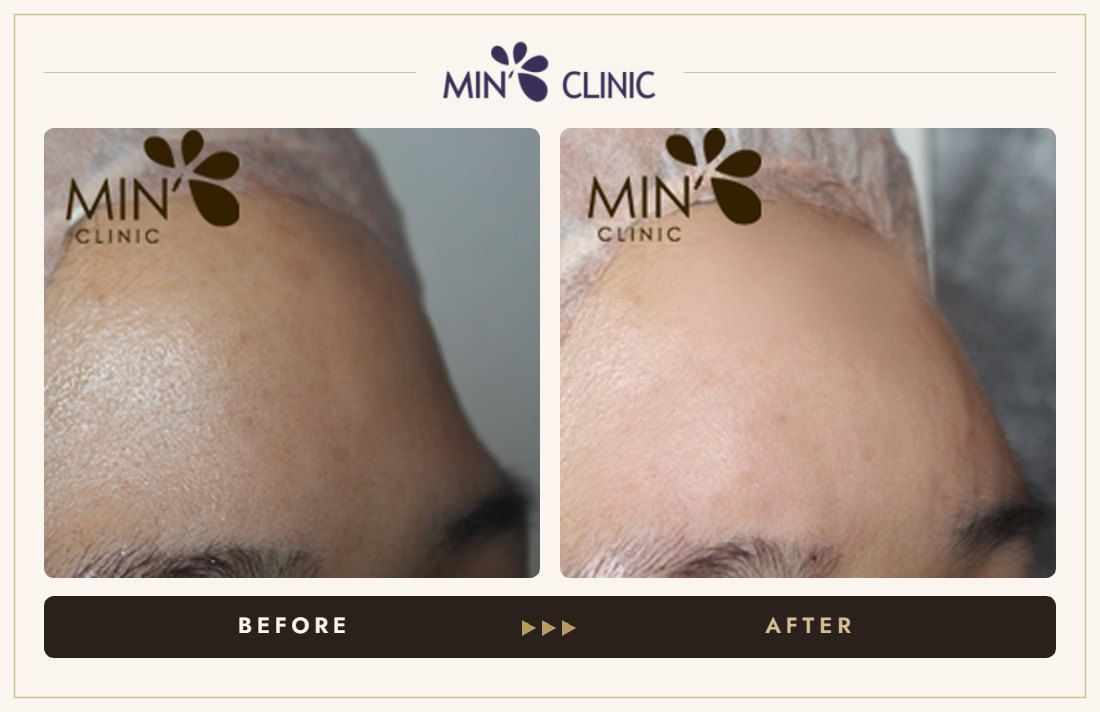 Forehead filler before and after, case 23 – MIN Clinic Seoul