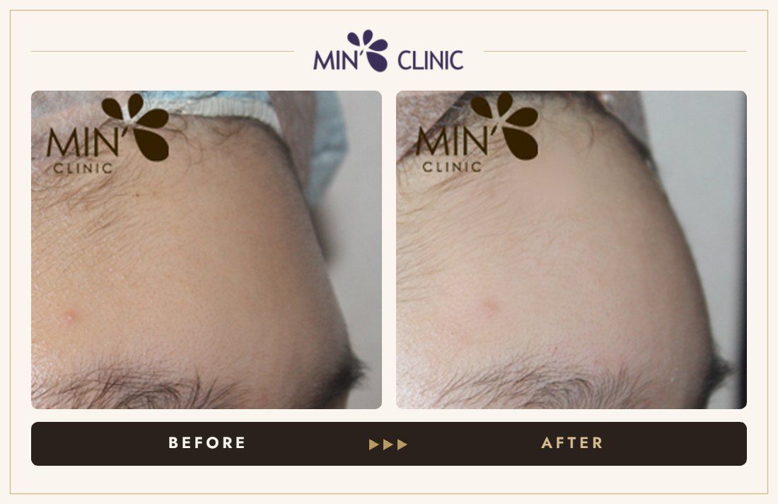 Forehead filler before and after, case 24 – MIN Clinic Seoul