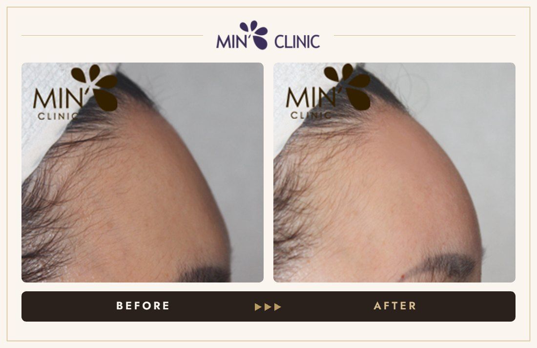 Forehead filler before and after, case 25 – MIN Clinic Seoul