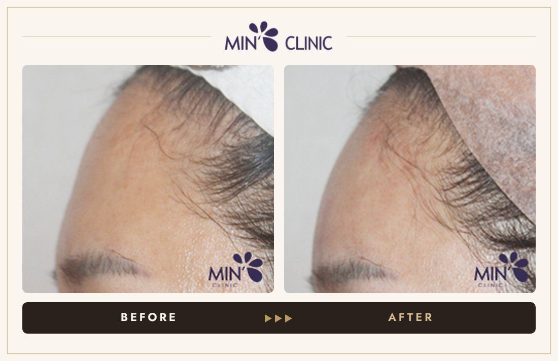 Forehead filler before and after, case 26 – MIN Clinic Seoul