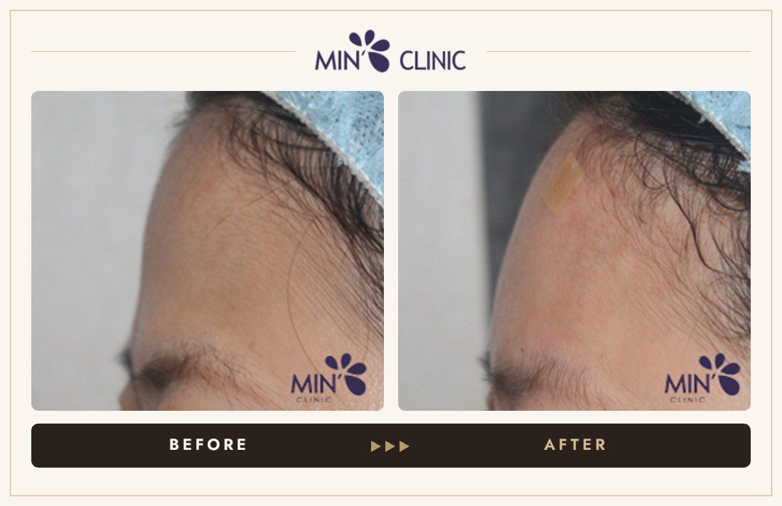 Forehead filler before and after, case 27 – MIN Clinic Seoul