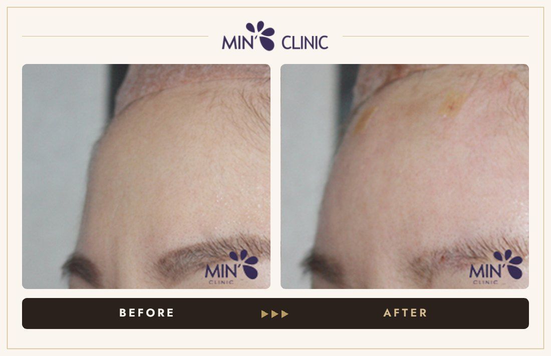 Forehead filler before and after, case 28 – MIN Clinic Seoul