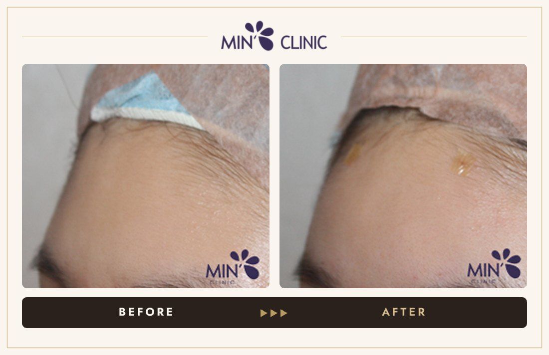 Forehead filler before and after, case 29 – MIN Clinic Seoul