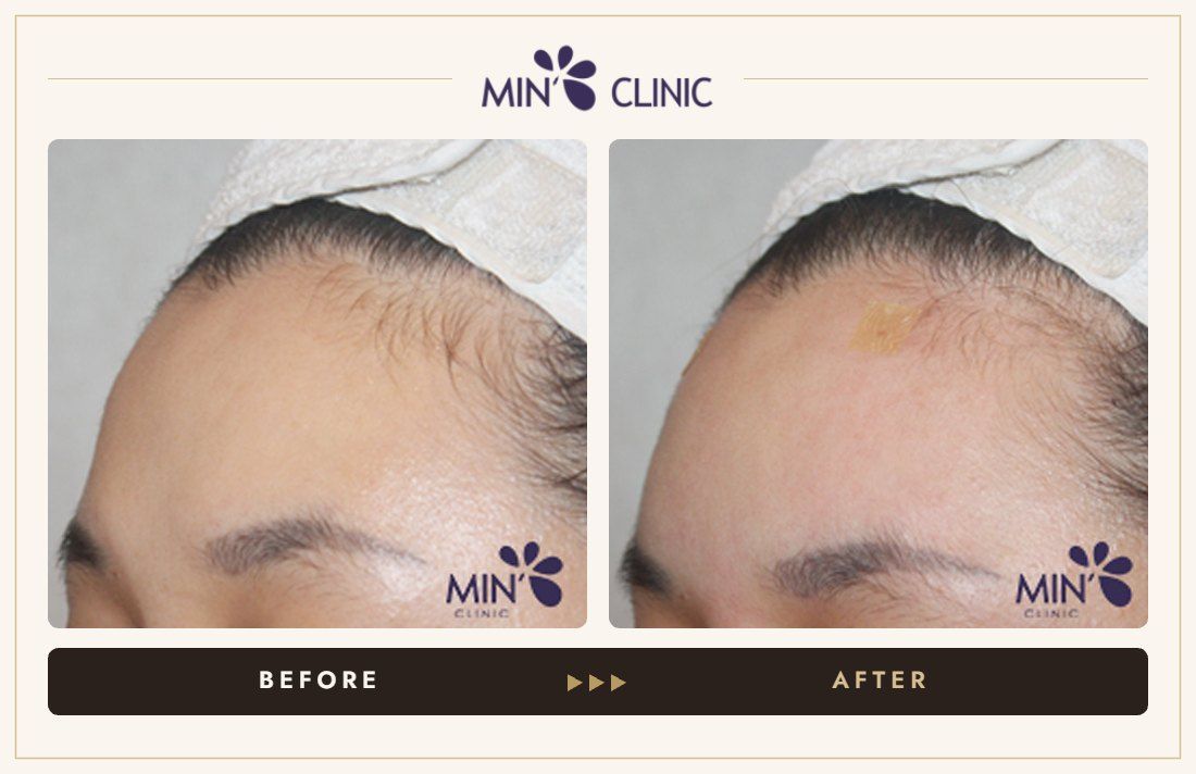 Forehead filler before and after, case 30 – MIN Clinic Seoul