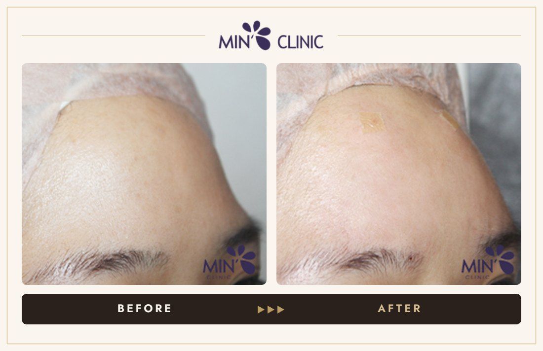 Forehead filler before and after, case 31 – MIN Clinic Seoul