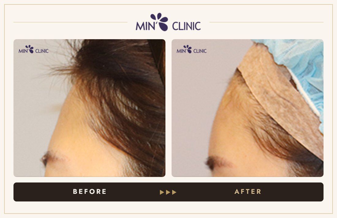 Forehead filler before and after, case 32 – MIN Clinic Seoul