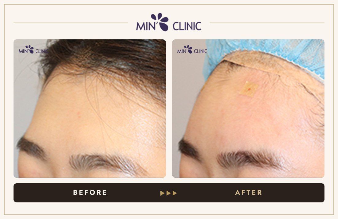 Forehead filler before and after, case 33 – MIN Clinic Seoul