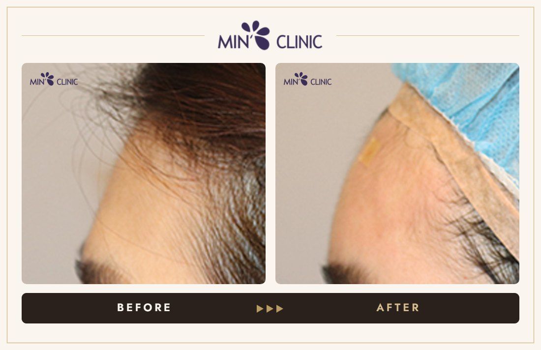 Forehead filler before and after, case 34 – MIN Clinic Seoul