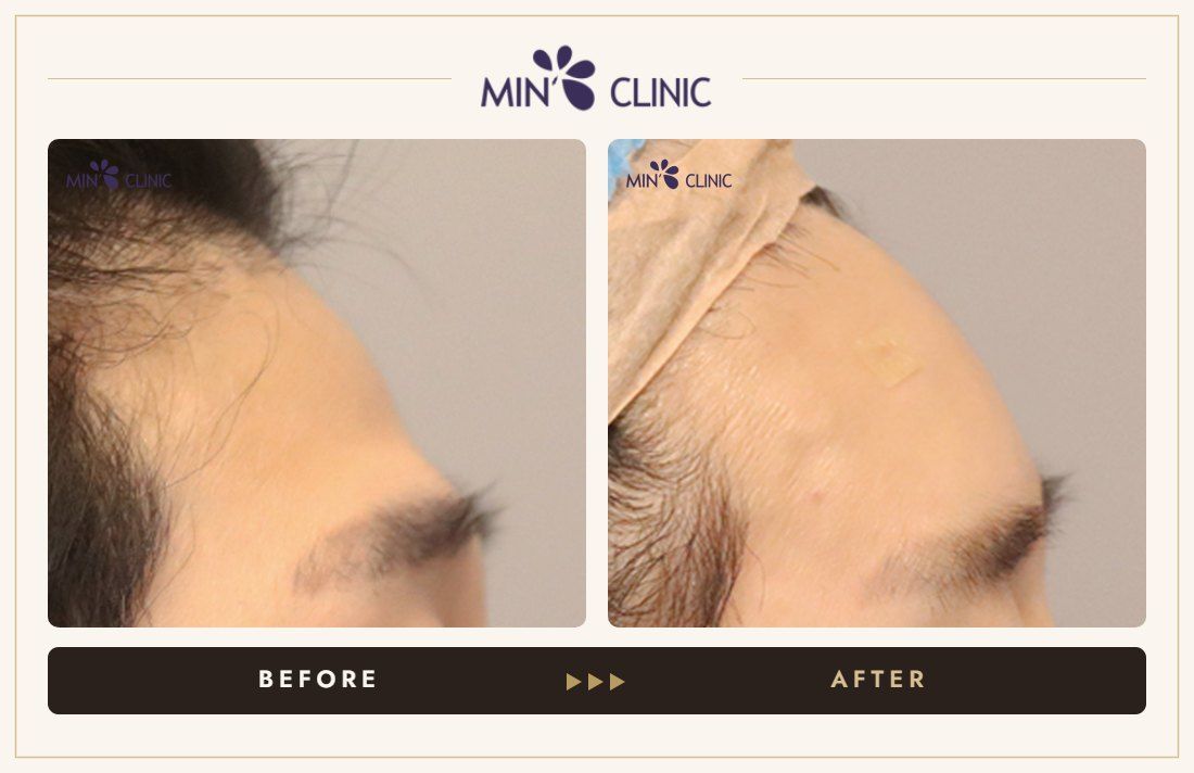 Forehead filler before and after – MIN Clinic Gangnam, Seoul
