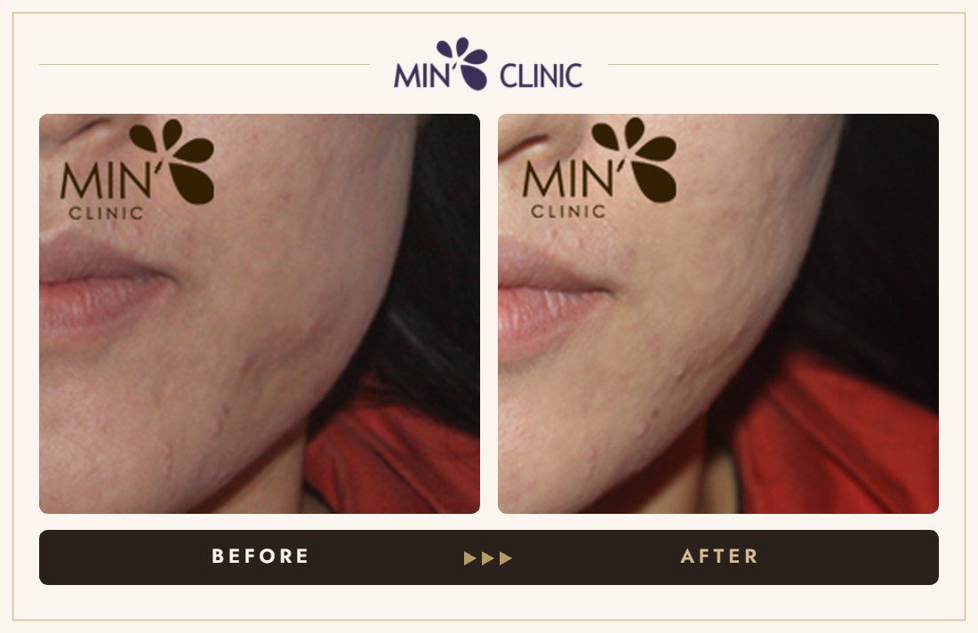 Jaw Botox before and after, case 19 – MIN Clinic Seoul