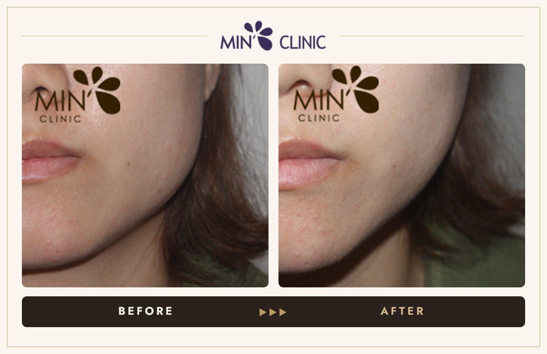 Jaw Botox before and after, case 20 – MIN Clinic Seoul
