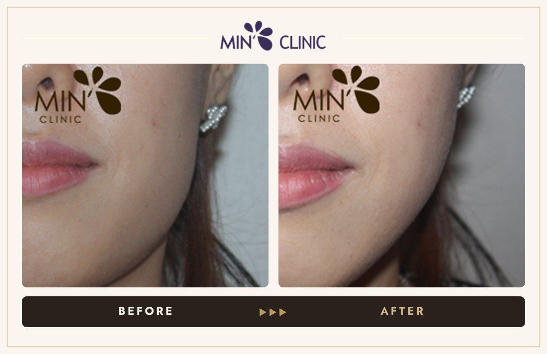 Jaw Botox before and after, case 21 – MIN Clinic Seoul