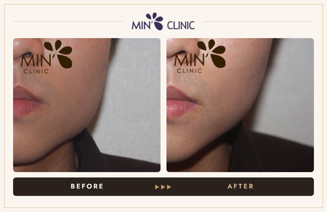 Jaw Botox before and after, case 22 – MIN Clinic Seoul