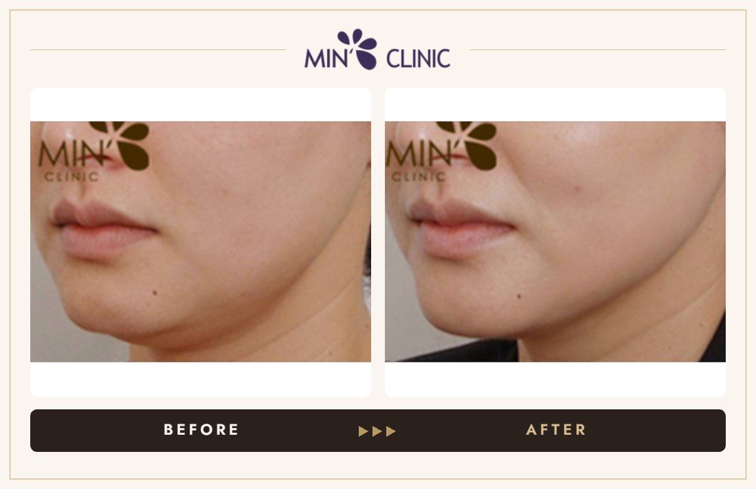 Ulthera lifting before and after, case 5 – MIN Clinic Seoul