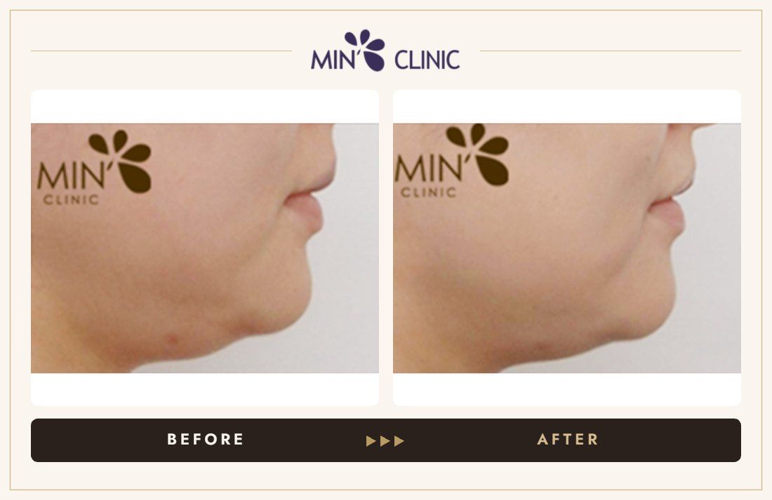 Ulthera lifting before and after, case 6 – MIN Clinic Seoul