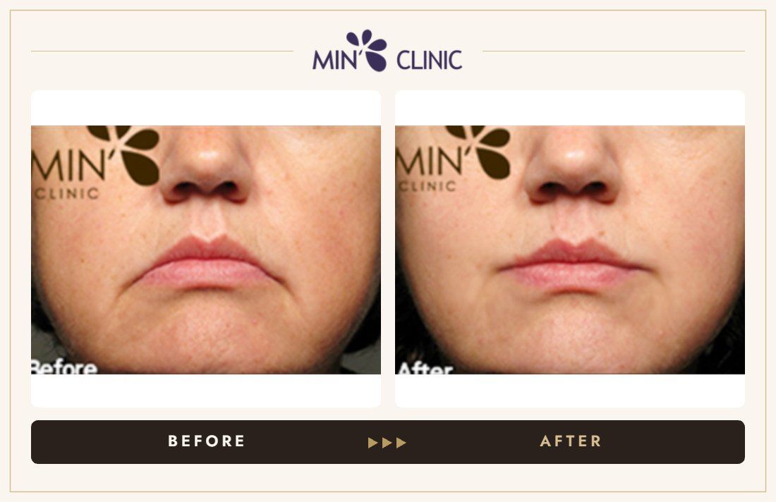 Ulthera lifting before and after, case 7 – MIN Clinic Seoul