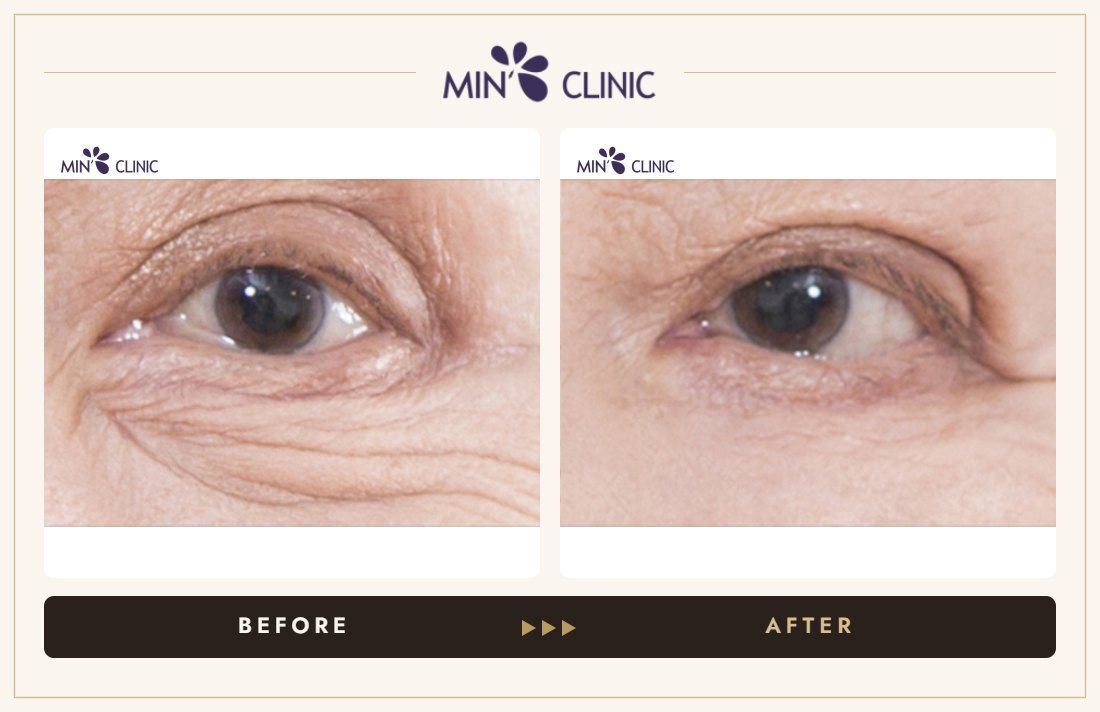 Eye lifting before and after, case 1 – MIN Clinic Seoul