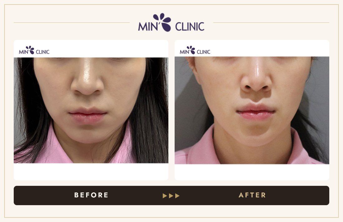 ONDA lifting before and after, case 9 – MIN Clinic Seoul