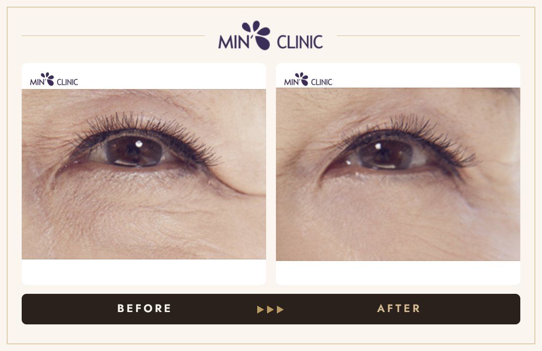 Eye lifting before and after, case 2 – MIN Clinic Seoul