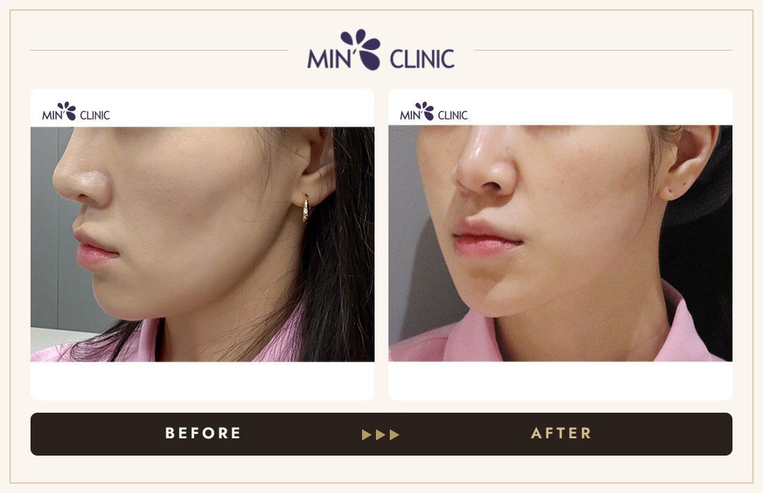 ONDA lifting before and after, case 10 – MIN Clinic Seoul