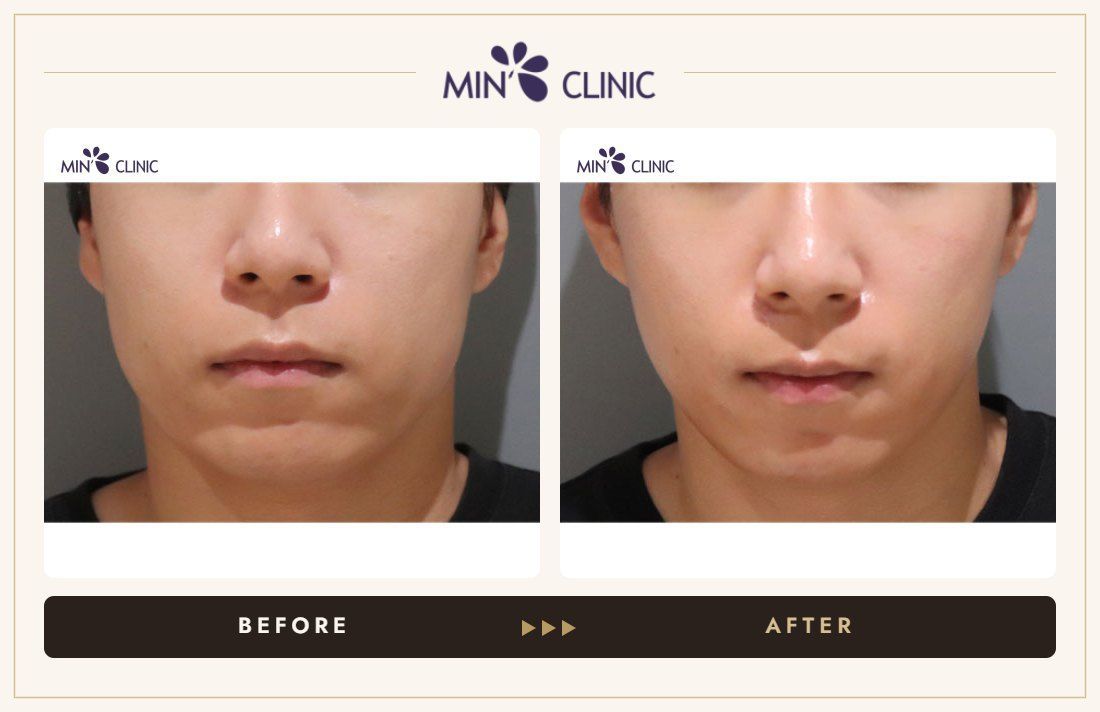 ONDA lifting before and after, case 11 – MIN Clinic Seoul
