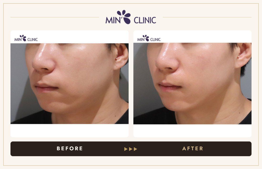 ONDA lifting before and after, case 12 – MIN Clinic Seoul