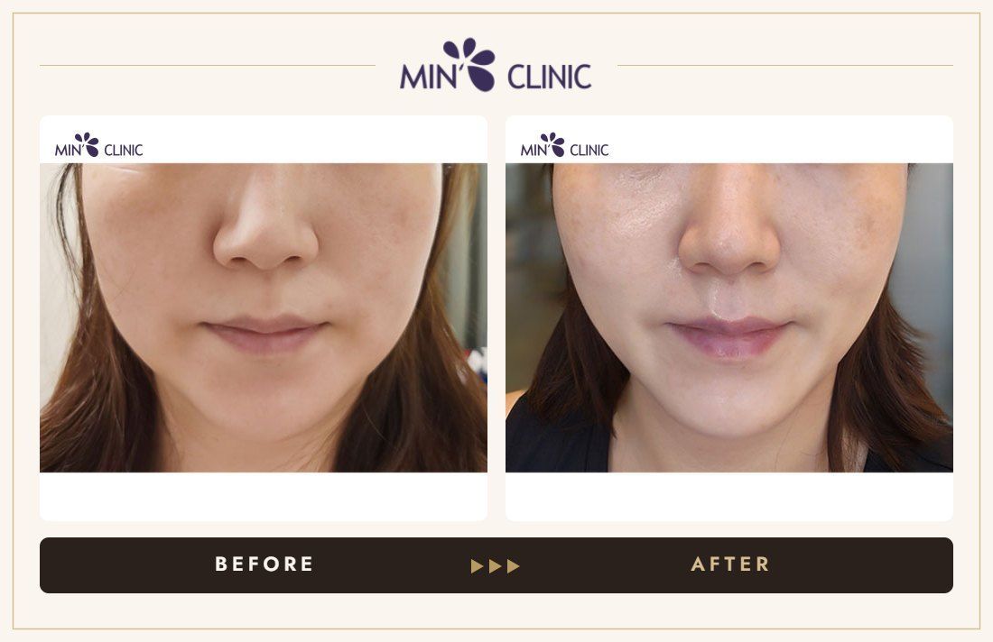ONDA lifting before and after, case 13 – MIN Clinic Seoul